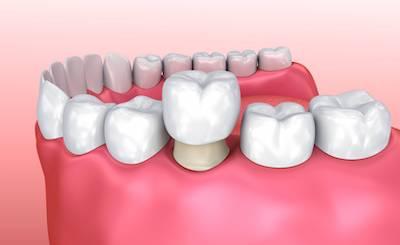 Dental crown covering damaged tooth in Rockville, MD