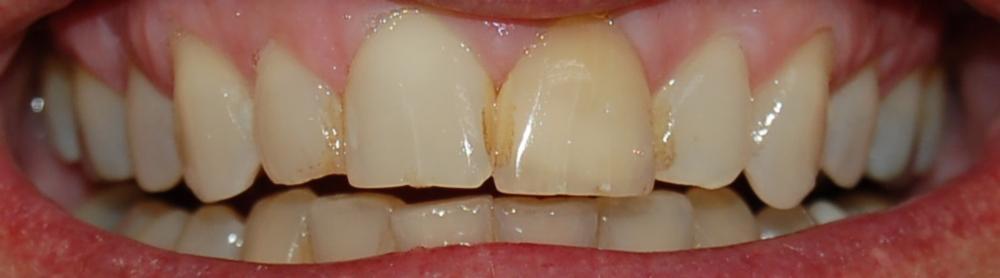 Teeth before internal bleaching at dentist in Rockville, MD