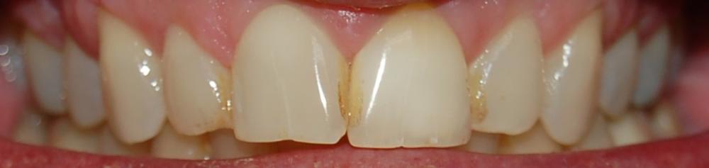 Close up of teeth after internal bleaching at dentist in Rockville, MD