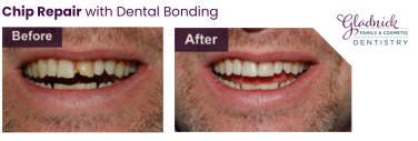 dentist in rockville | before and after chip repair