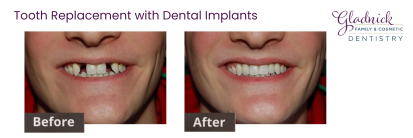 before and after photos dental implants
