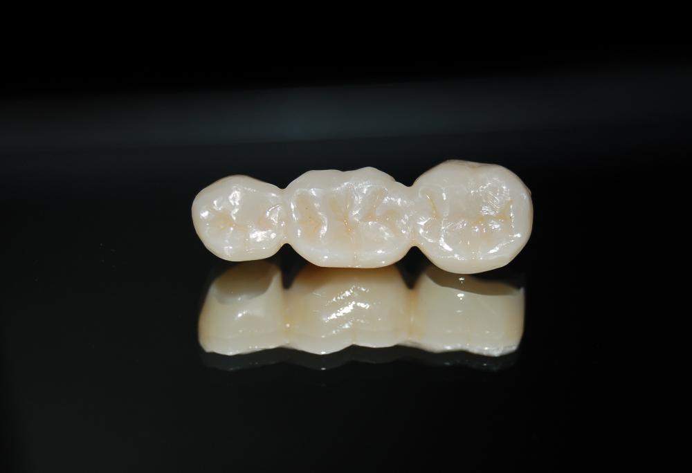 Dental bridge at dentist in Rockville, MD