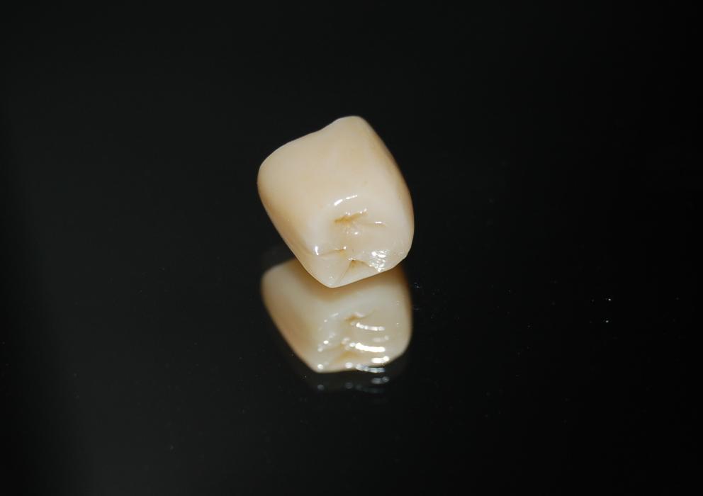 Tooth crown at dentist office in Rockville, MD