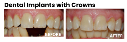 dental implants rockville | dental implants before and after