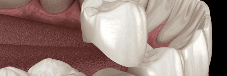 Digital diagram of dental crown covering tooth in Rockville, MD