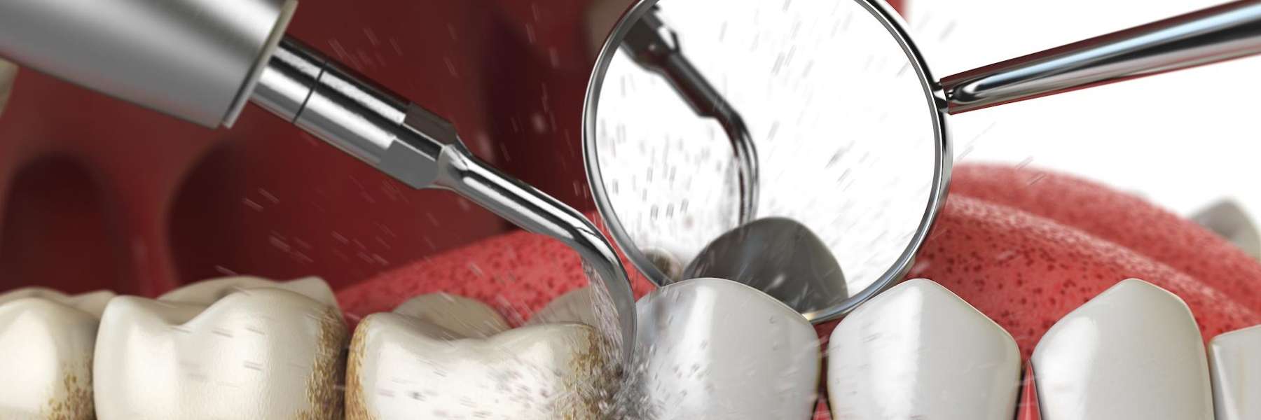 scaling and root planing rockville