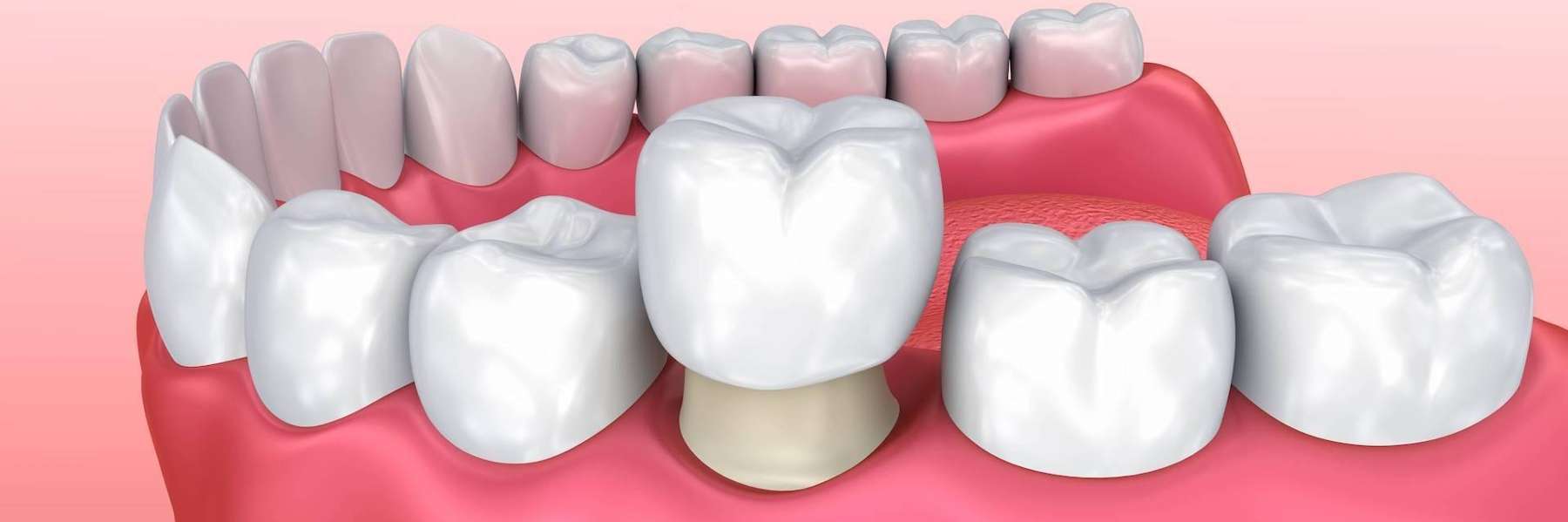 repair broken teeth | dental crowns rockville