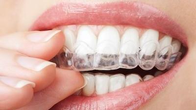 Close up of patient putting on Invisalign in Rockville, MD