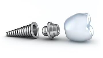 Implant screw and dental crown in Rockville, MD