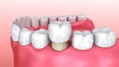 Dental crown covering tooth at dentist in Rockville, MD