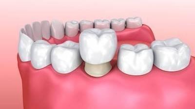 Dental crown Rockville, MD