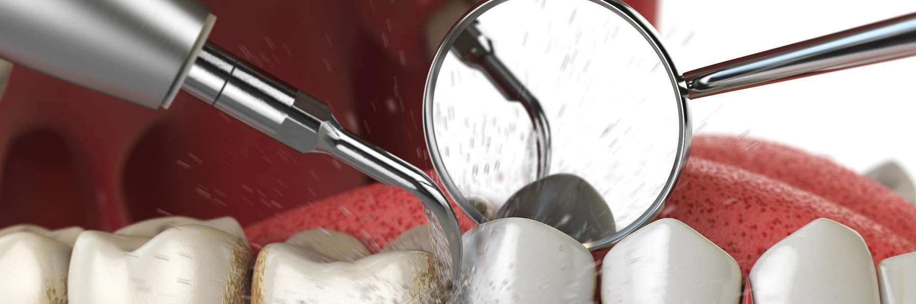 emergency dentist rockville | teeth cleaning