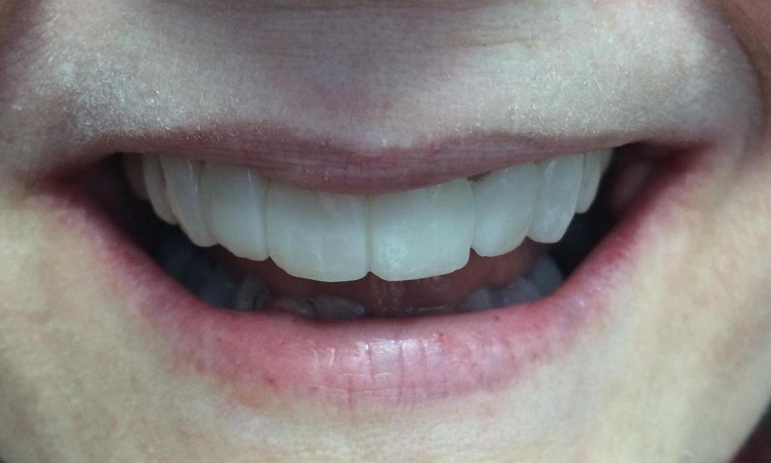After Veneers | Rockville, MD | Gladnick Family & Cosmetic Dentistry