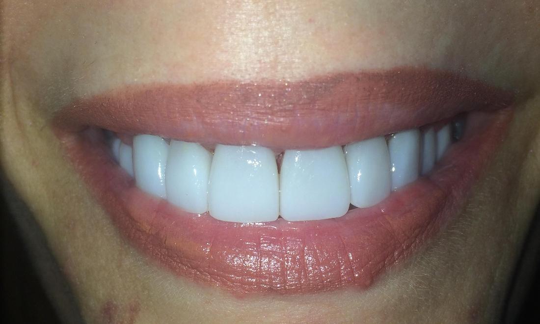 Porcelain Veneers After | Rockville, MD | Gladnick Family & Cosmetic Dentistry