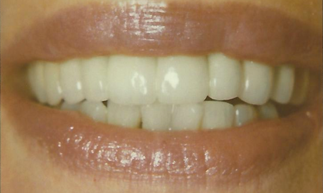 Corrected Ceramic Bridge | Rockville, MD | Gladnick Family & Cosmetic Dentistry