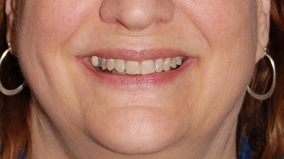 After ClearCorrect Straight Teeth | Rockville, MD | Gladnick Family & Cosmetic Dentistry