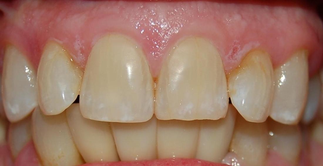 After dental implants | Cosmetic Dentistry Rockville MD