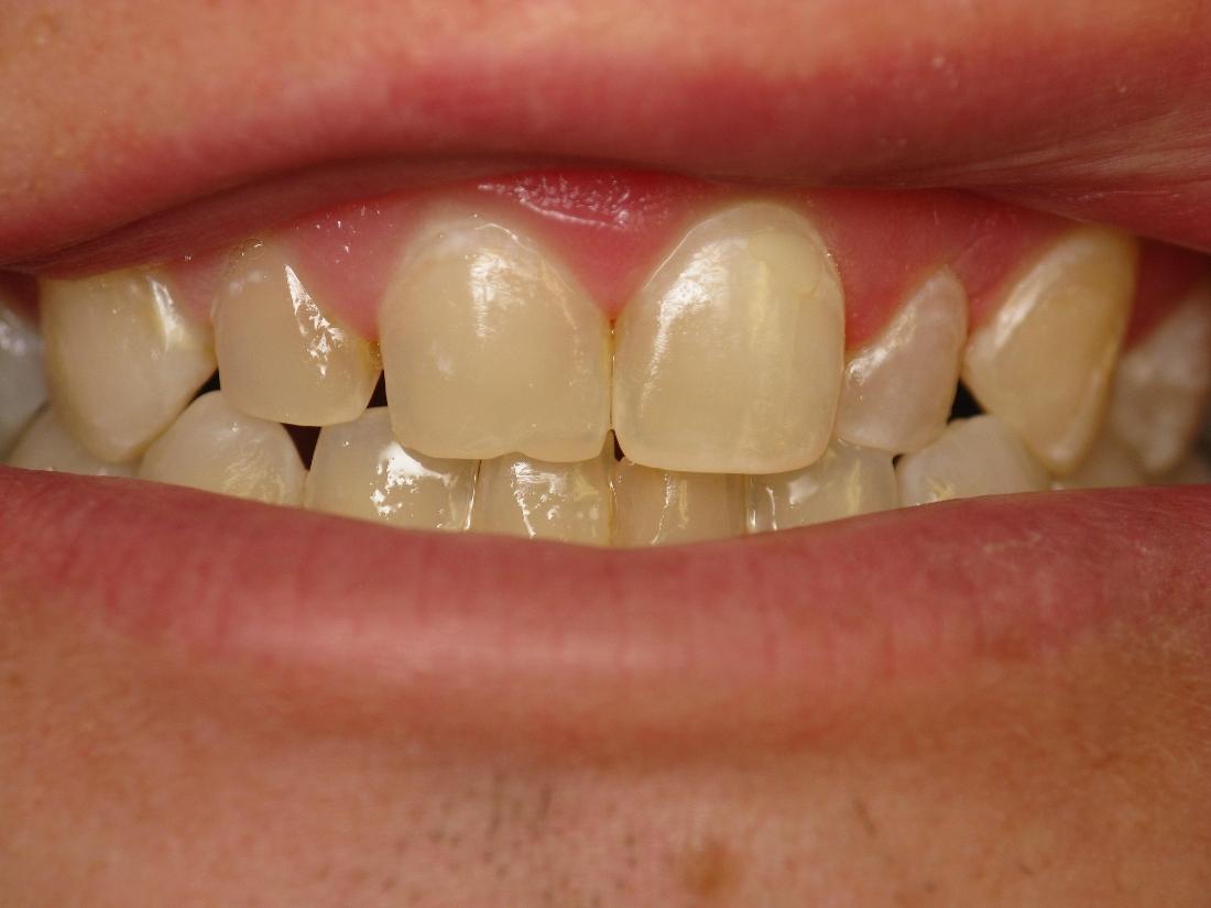 After whitened fillings | Rockville, MD | Gladnick Family & Cosmetic Dentistry