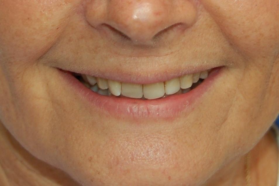 Teeth Grinding | Rockville, MD | Gladnick Family & Cosmetic Dentistry