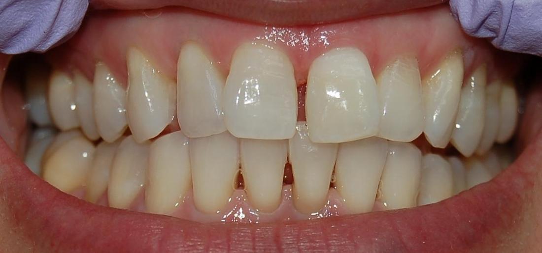 Matching White Teeth | Rockville, MD | Gladnick Family & Cosmetic Dentistry