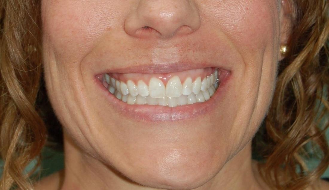 Patient's teeth after Invisalign in Rockville, MD