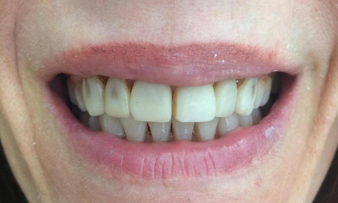 Dental Veneers Before | Rockville, MD | Gladnick Family & Cosmetic Dentistry