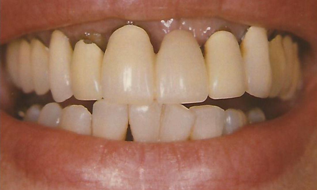 Before mis-fitting bridge | Rockville, MD | Gladnick Family & Cosmetic Dentistry