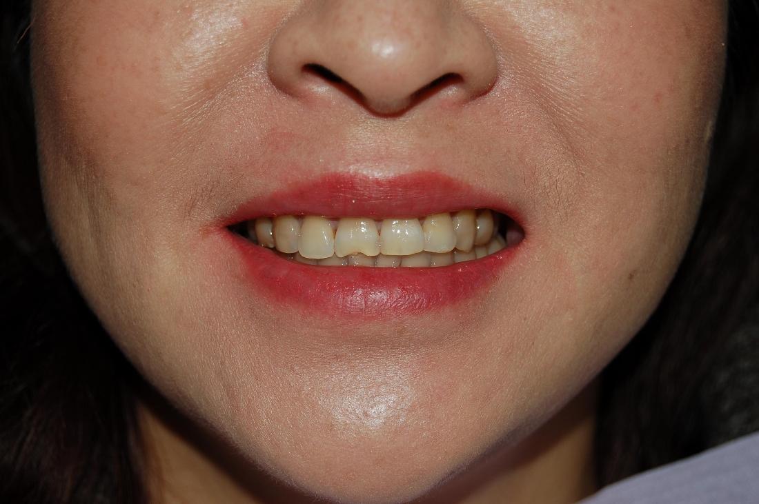 Patient with chipped front tooth at dentist in Rockville