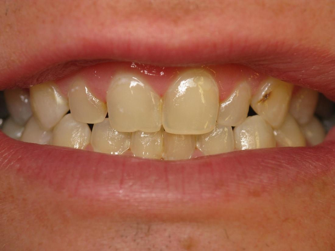 Before old fillings | Rockville, MD | Gladnick Family & Cosmetic Dentistry