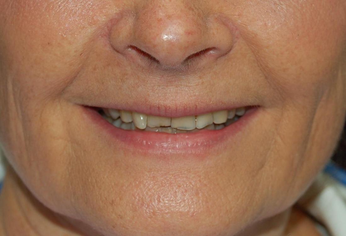 Grinding Teeth Before | Rockville, MD | Gladnick Family & Cosmetic Dentistry