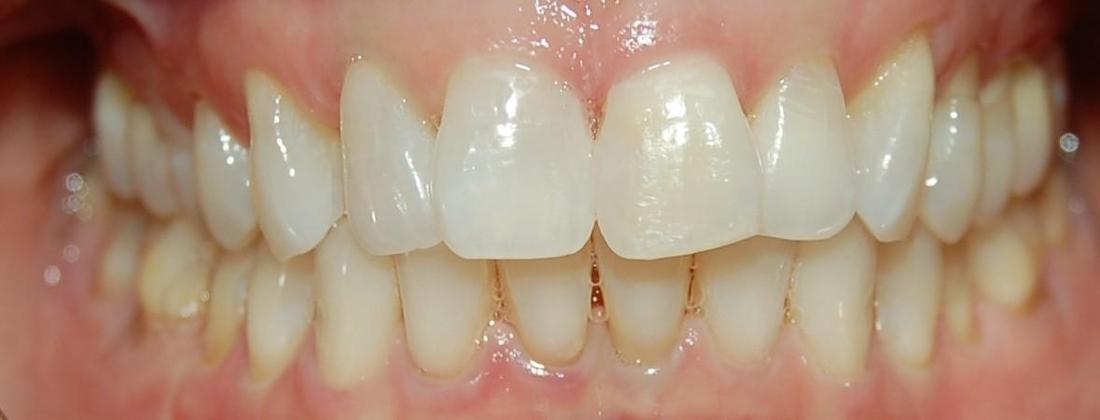 Patients teeth after dental bonding in Rockville, MD