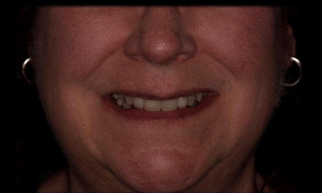 Veneers in Rockville