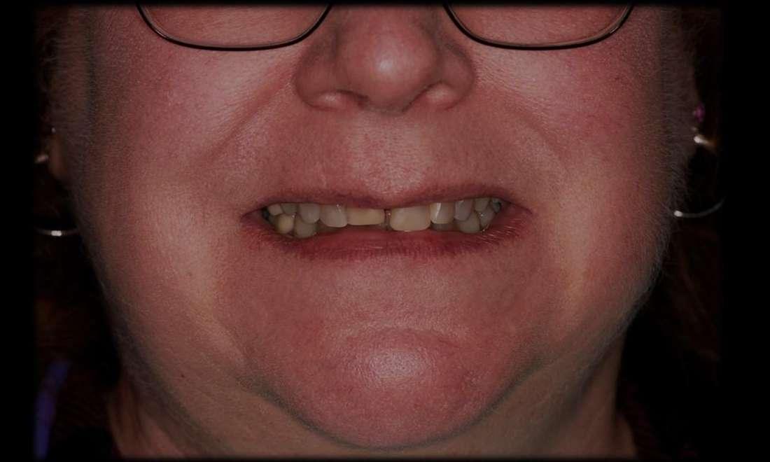 Veneers in Rockville