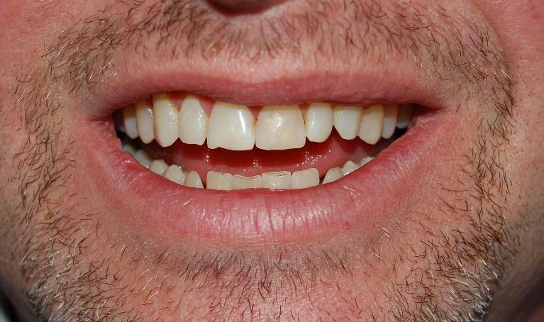 Patient's teeth after broken front tooth repair in Rockville, MD