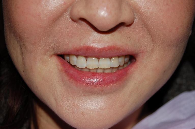 Patient's teeth after chipped front tooth repair in Rockville, MD
