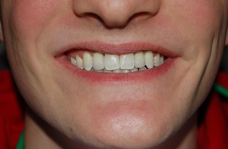 Implants-After-Image