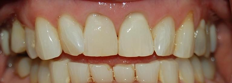 After Dental Bonding | Dental Bonding Rockville MD