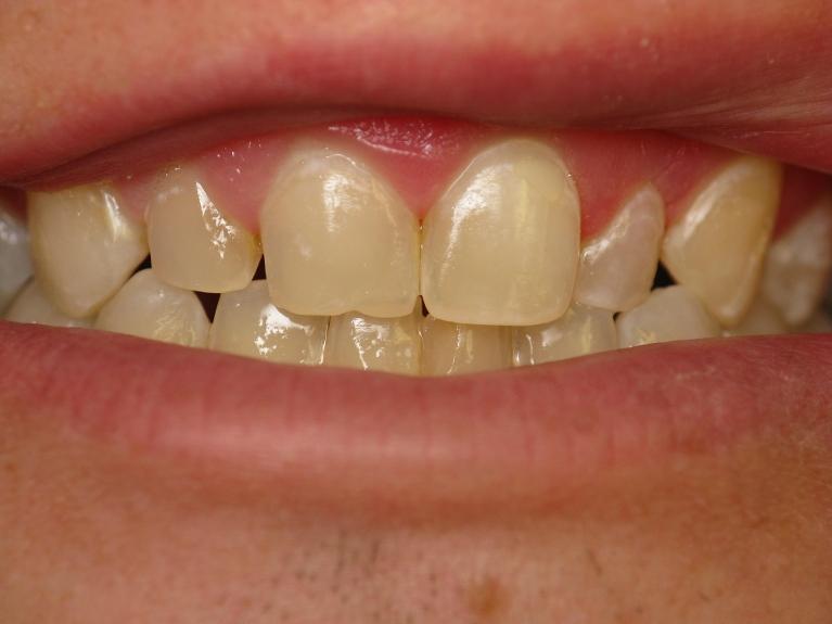 After whitened fillings | Rockville, MD | Gladnick Family & Cosmetic Dentistry