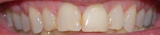 After internal bleaching | Rockville, MD | Gladnick Family & Cosmetic Dentistry