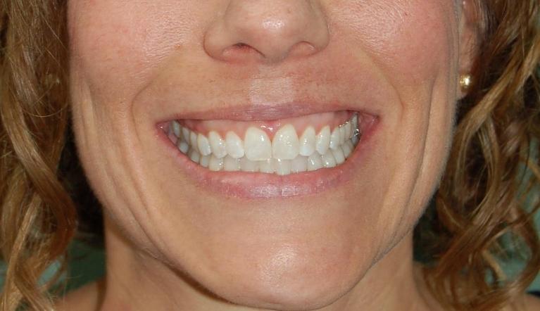 Patient's teeth after Invisalign in Rockville, MD