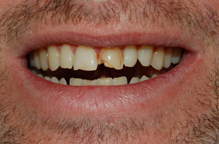 Patient with broken front tooth at emergency dentist in Rockville