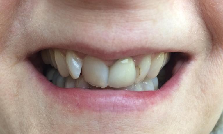 Before Veneers | Rockville, MD | Gladnick Family & Cosmetic Dentistry