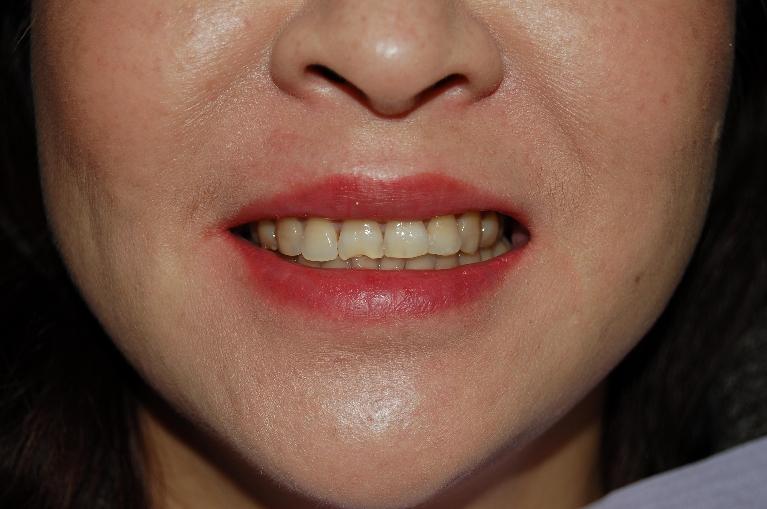 Patient with chipped front tooth at dentist in Rockville