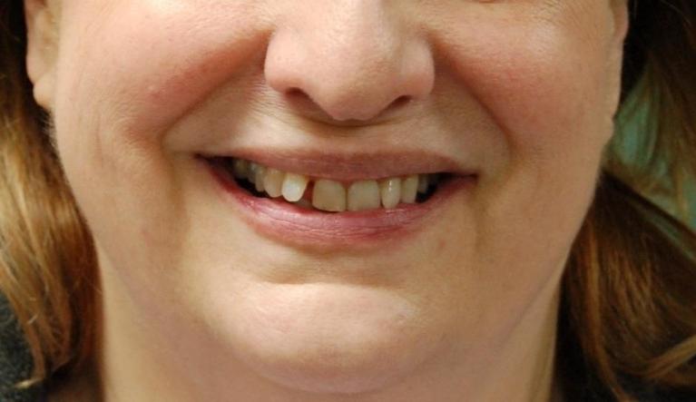 Before Clear Aligners | Rockville, MD | Gladnick Family & Cosmetic Dentistry