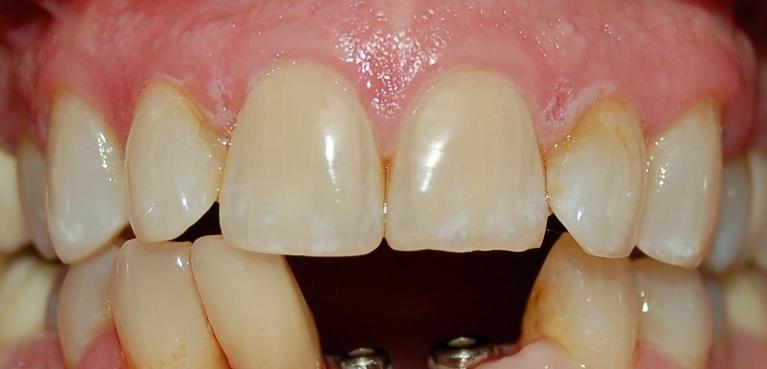 Dental-Implants-Before-Image