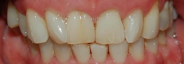 Before Dental Bonding | Cosmetic Dentist Rockville MD