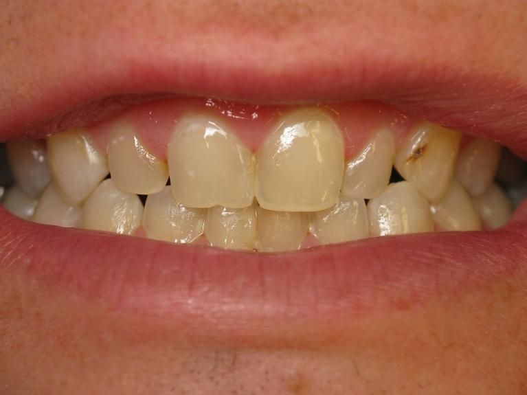 Before old fillings | Rockville, MD | Gladnick Family & Cosmetic Dentistry