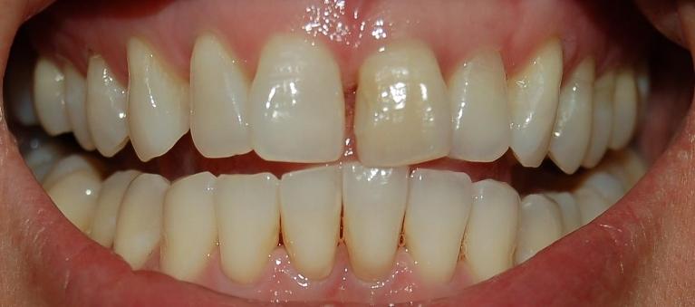 Internal Bleaching | Rockville, MD | Gladnick Family & Cosmetic Dentistry