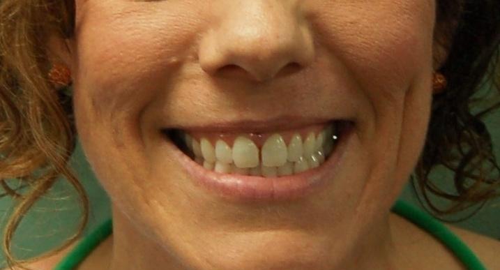 Patient's teeth before Invisalign in Rockville, MD