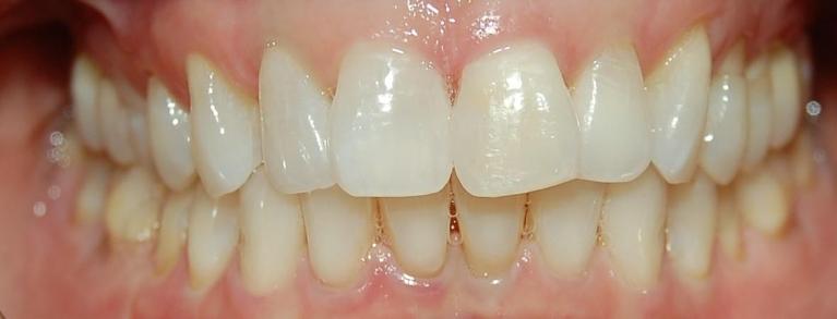 Patients teeth after dental bonding in Rockville, MD